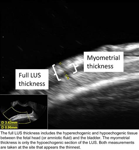 measuring uterine scar thickness on ultrasound|myometrial thickness chart.